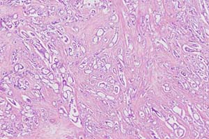 The overwhelming bulk of this carcinoma shows tubular differentiation. It is morphologically of NST type and NOT a Tubular Carcinoma